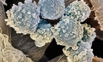 Leucemia