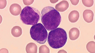 Leucemia