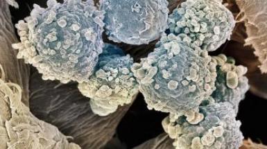 Leucemia